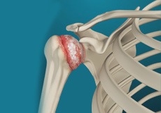 Arthritis of the Shoulder