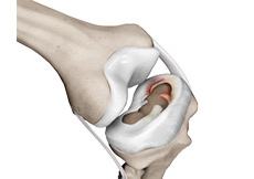 Meniscal Injuries