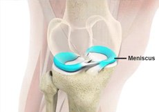 Meniscal Surgery