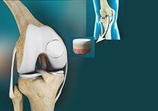 Osteochondral Defect of the Knee