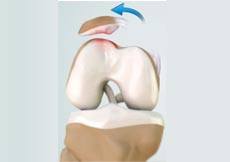 Patellar Dislocation/Patellofemoral Dislocation