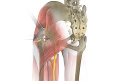 Posterior Hip Replacement