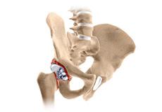 Revision Hip Replacement