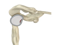 Shoulder Labral Tear