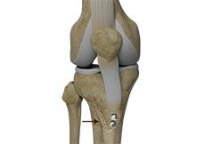 Tibial Tubercle Transfer