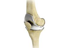 Total Knee Replacement