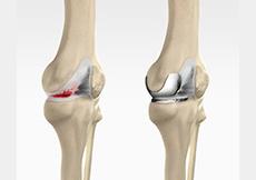 Unicompartmental/Partial Knee Replacement