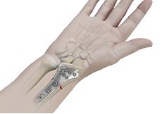 Wrist Open Reduction and Internal Fixation